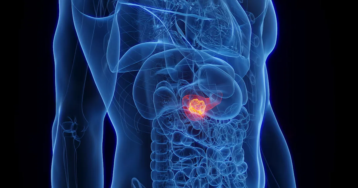 Estudo testa análise de sinais biológicos para antecipar câncer de pâncreas