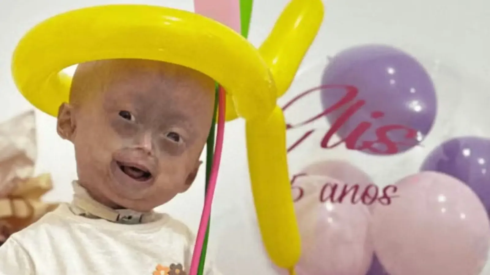 Elis Lima Carneiro, diagnosticada com progéria, morre aos 5 anos em Boa Vista